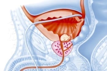 Reprostat