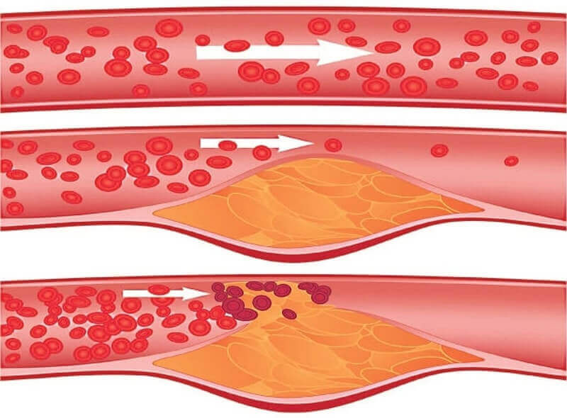 Cardiotensive